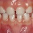 Inflammatory root resorption in primary molars: prevalence and associated